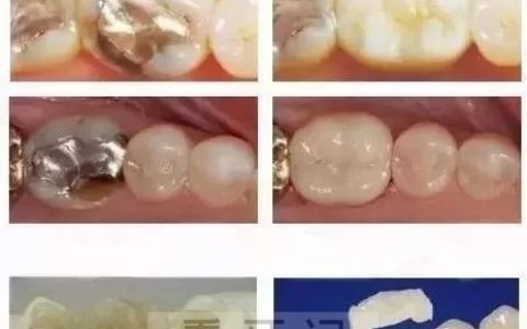 金属嵌体与瓷嵌体照片对比