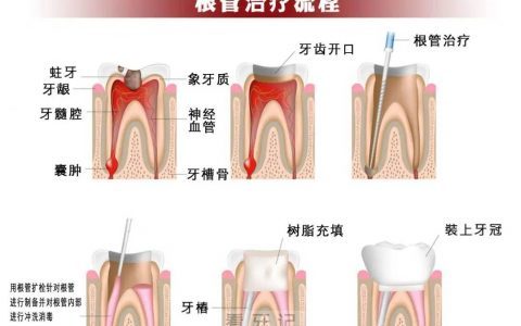 根管治疗需要去几次医院？整个过程要多久？答案来了