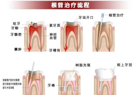 根管治疗需要去几次医院？整个过程要多久？答案来了