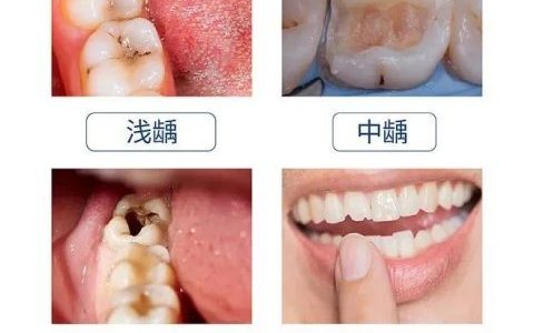 什么是龋齿？附龋齿各阶段图片