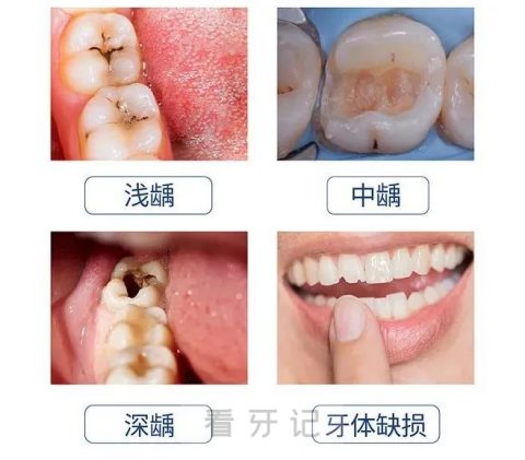 什么是龋齿？附龋齿各阶段图片