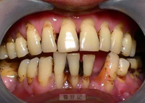 太可怕了！牙周病牙周炎图片整理