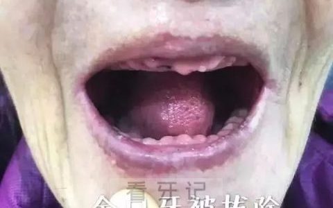 太可怕了！千万不要全口拔牙（这样的牙医太坏了！）