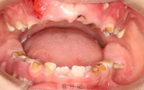太可怕了！孩子一口烂牙几乎烂光图片