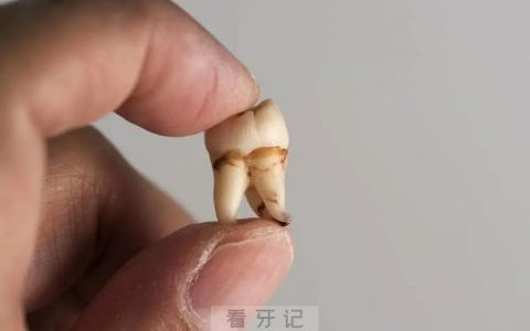 最贵的智齿长什么样？最新照片来了