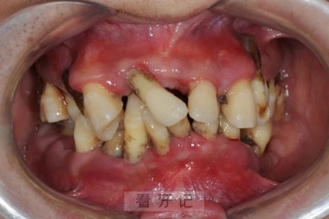 牙周脓肿牙龈萎缩严重图片照片对比