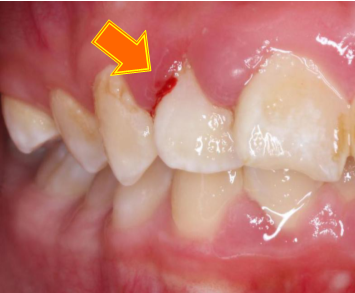 牙龈红肿出血图片照片对比
