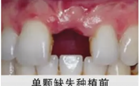 种植牙种植前后对比图