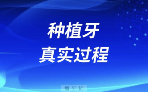 良心牙医告诉你种植牙真实过程