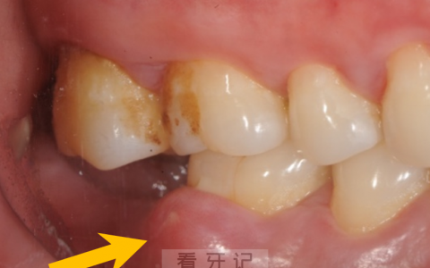 牙周脓肿牙龈萎缩严重图片照片对比