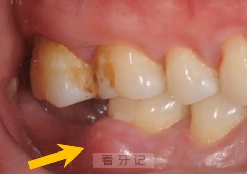牙周脓肿牙龈萎缩严重图片照片对比