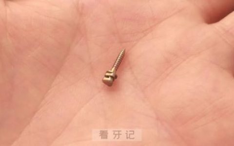 什么是正畸骨钉（附图片）什么情况需要打骨钉？