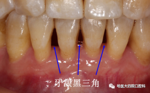 牙齿黑三角是什么意思？真实图片