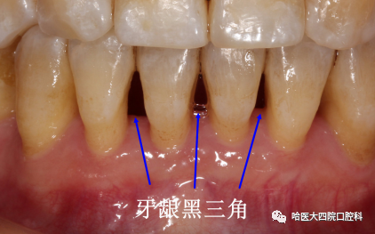 牙齿黑三角是什么意思？真实图片