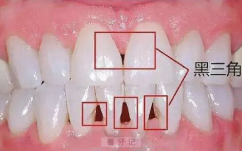 牙齿黑三角最新演示图片