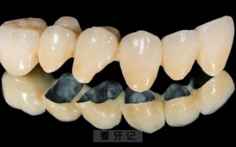 烤瓷牙全瓷牙真实图片对比