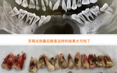 太可怕了！牙周炎拖到最后会导致什么后果？