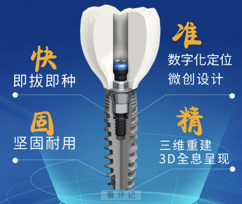 立得用种植牙介绍