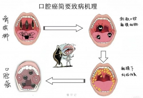 嚼槟榔导致口腔癌原理