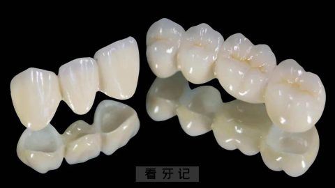 烤瓷牙全瓷牙真实图片对比