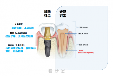 种植牙和真实牙的区别对比图