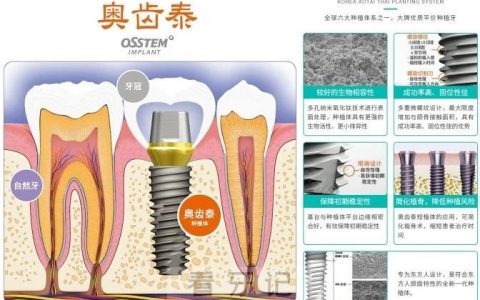种牙选登腾还是奥齿泰？韩国两大种植体品牌谁是最好的？
