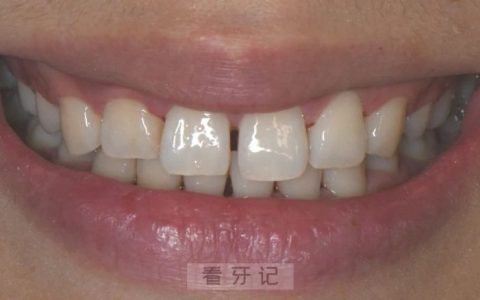 女性牙缝大图片