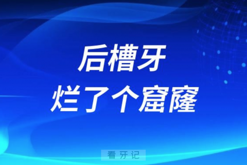 后槽牙烂了个大窟窿还能补牙吗？