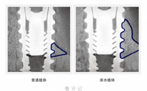 家里老人用亲水种植体有必要吗？是不是智商税？