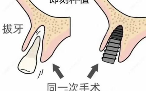 即刻种植费用会比普通种植牙高很多吗？
