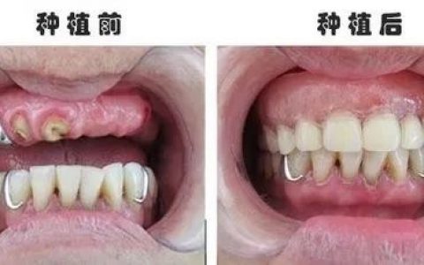 一分钟了解什么是种植牙