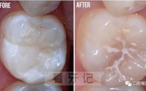 为什么国家要求学校免费窝沟封闭？原因解读2024