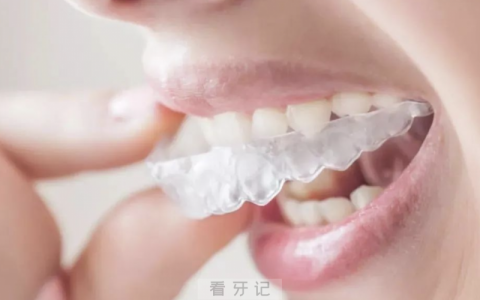 什么是隐适美？好在哪里？