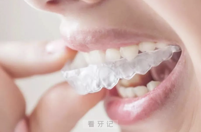 什么是隐适美？好在哪里？