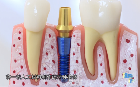 什么是种植牙？有哪些优点？流程是什么？这篇文章能给你说清楚了