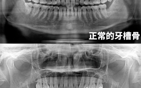 吸烟对种植牙危害有多大？牙槽骨吸收对比图来了