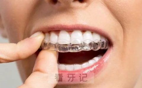 为什么隐形牙套这么贵？具体贵在哪里？好在哪里？