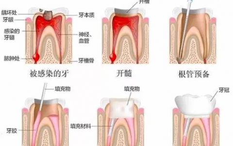 良心牙医说得了牙髓炎吃消炎药没用