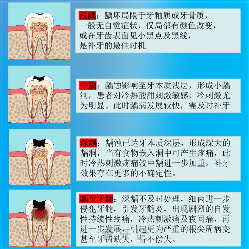 蛀牙龋齿严重程度自我对照表