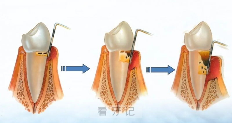 轻度中度重度牙周病症状