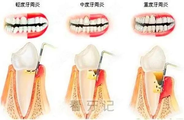 轻度中度重度牙周病症状