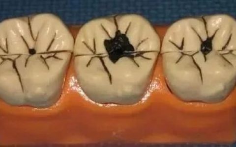 牙齿出现黑线真实图片