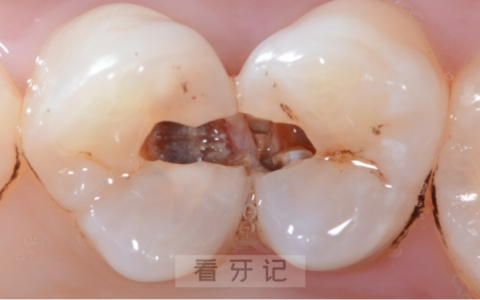 孩子得了龋齿真实照片
