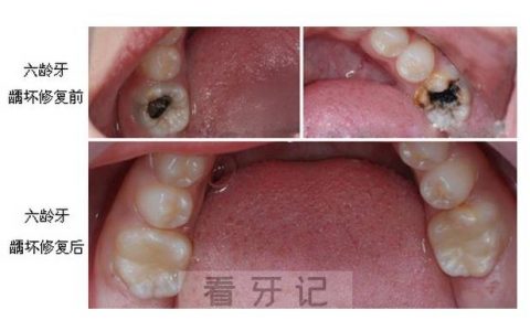 千万别给孩子拔牙（“六龄牙”虫牙）