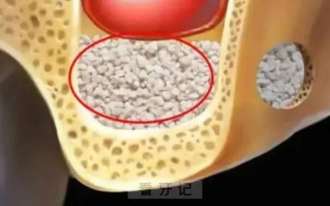 种植牙骨粉填充植骨后悔死了