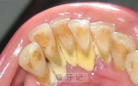 长期不洗牙导致牙结石真实照片