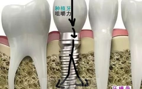 良心牙医告诉你老年人该选烤瓷牙还是选种植牙