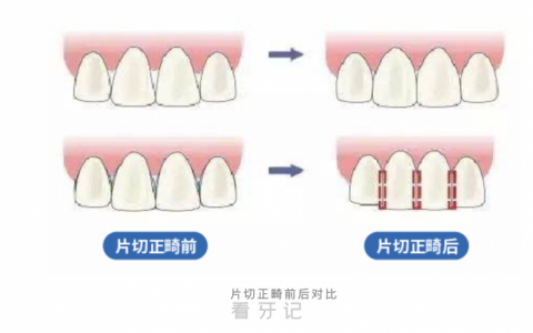 小孩子做矫正不拔牙还有别的办法吗？
