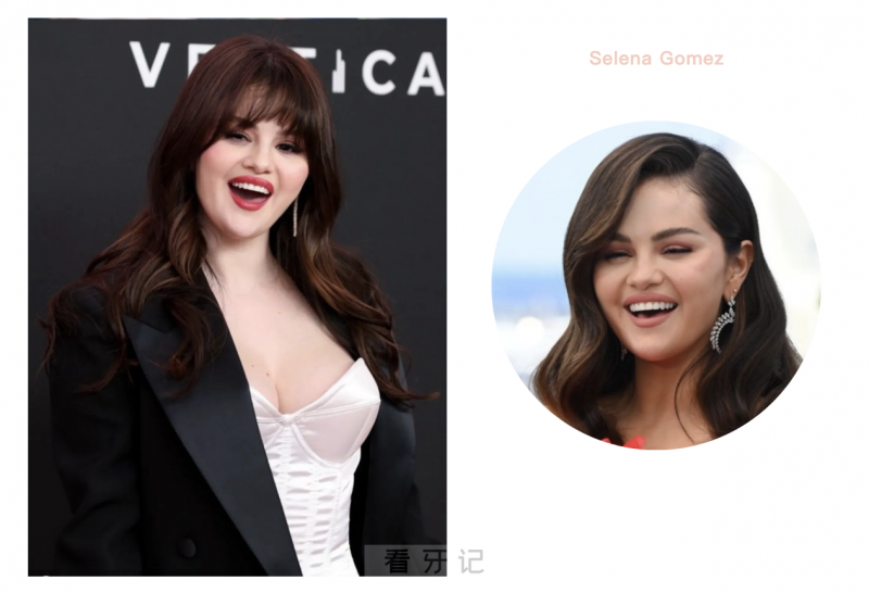 后悔死了？千万别做牙齿贴面，可能真的不适合你！