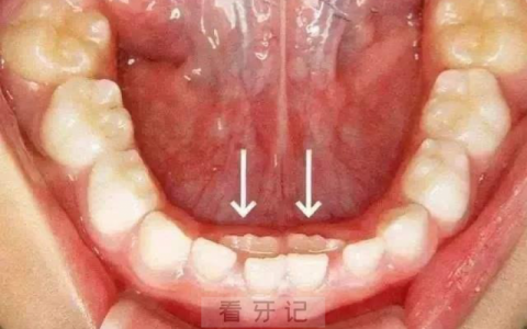 孩子长了双排牙意味着什么？或许是吃得太好了！！